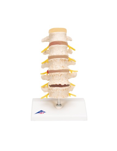 3B Scientific, Stages of intervertebral disc...