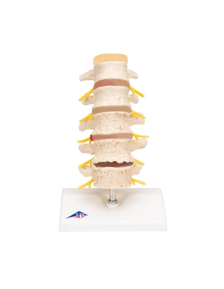3B Scientific, Stages of intervertebral disc herniation and degeneration of vertebra A795