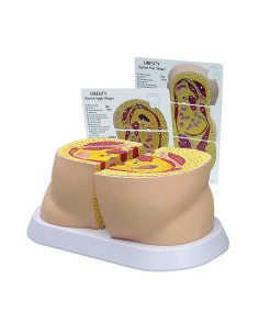 Obesity model 3B Scientific W33363 2