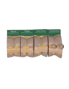 Erler Zimmer, modello anatomico di colon con patologie in...