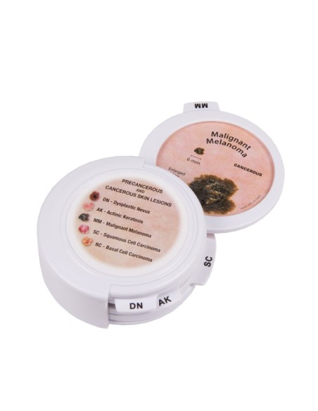 Kutane, präkanzeröse und kanzeröse Läsionen Erler Zimmer J56