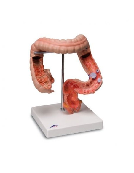 3B Scientific, anatomical model: pathologies of the intestine K55