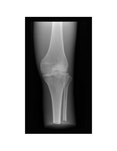 Radiology Simulator - Knee - Opaque - Erler Zimmer 7255