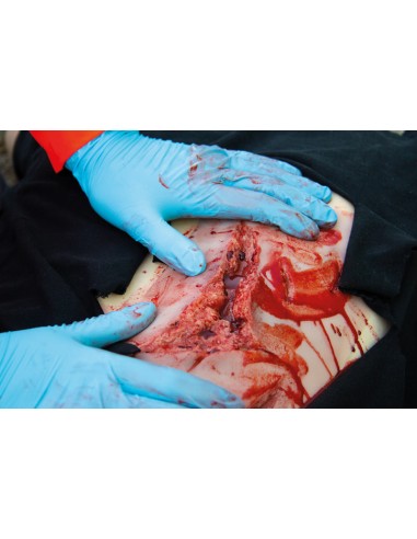 Moulage and simulation of large laceration with...