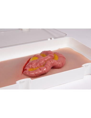 Moulage and simulation of abdominal wound with...