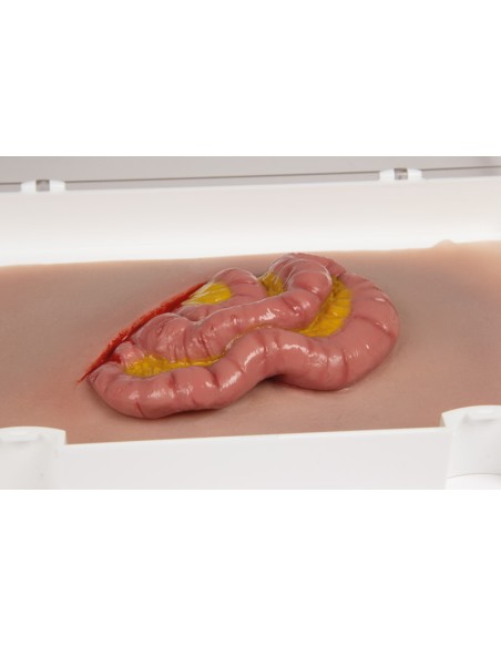 Moulage und Simulation einer abdominalen Wunde mit Dünndarmvorwölbung Erler Zimmer NW111