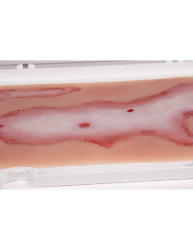 Moulage y simulación de herida escaldada Erler...