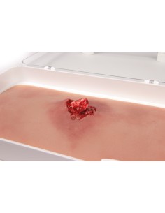 Moulage and simulation of arm wound with exposed fracture...