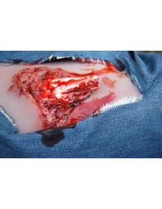 Moulage and simulation of leg wound with exposed fracture...