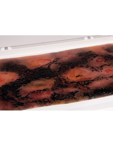 Moulage and simulation of third-degree burn Erler Zimmer NW107