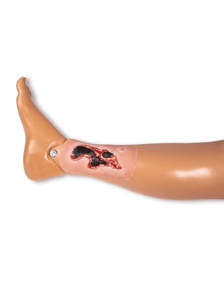 Moulage di ferita da ulcera arteriosa degli arti inferiori, piccola, in fase di essudazione Erler Zimmer PW004A