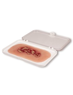 Moulage of venous leg ulcer, small, exudation phase PW002A