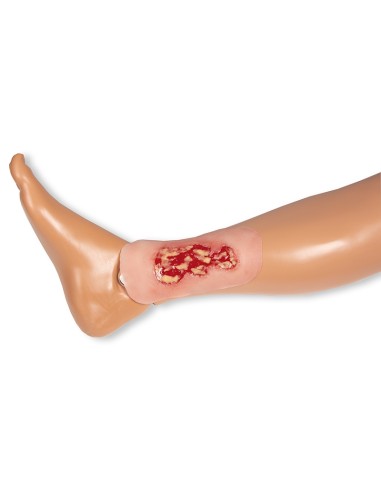 Moulage de úlcera venosa de pierna, pequeña,...