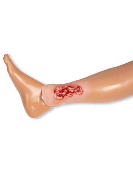 Moulage eines Ulcus cruris venosum, klein, Exsudationsphase PW002A