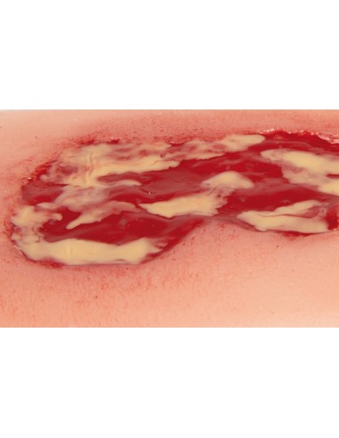 Moulage d'un ulcère veineux de jambe, petit,...