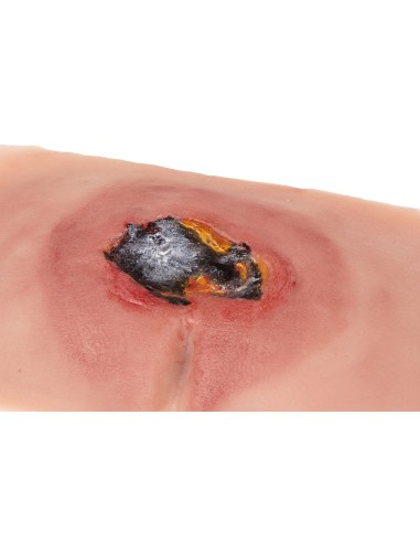 Moulage d'un ulcère de décubitus sacré non...