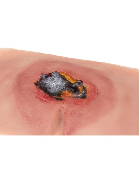 Moulage di ulcera da decubito sacrale non trattata PW001A