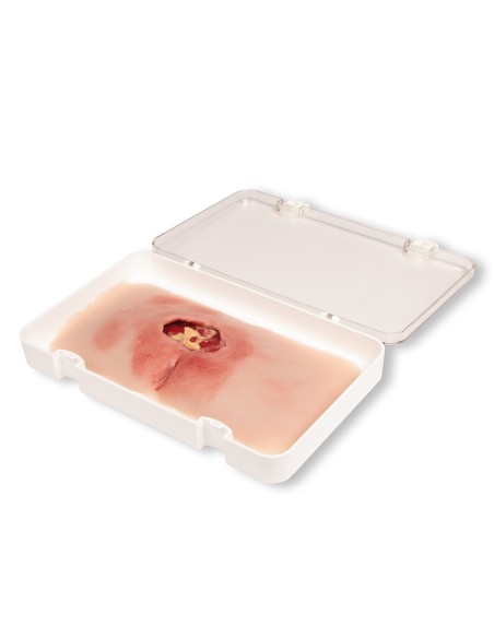 Moulage di ulcera da decubito sacrale pulita PW001B