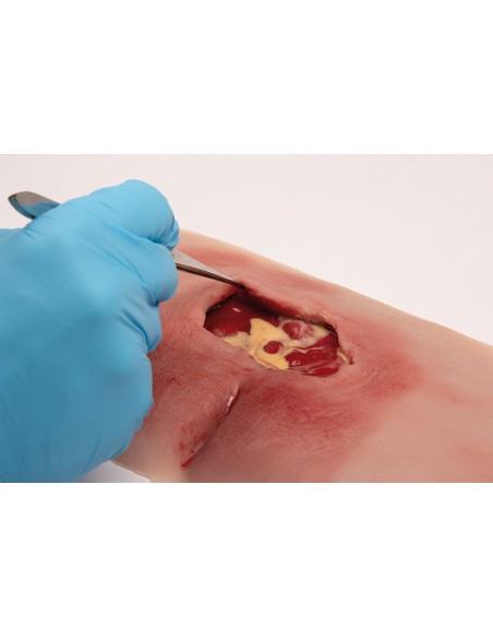 Moulage d'un ulcère de décubitus sacré propre PW001B