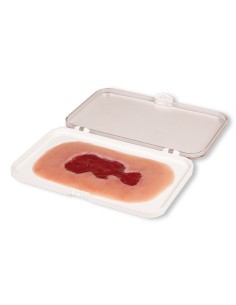 Moulage d'un ulcère veineux de jambe, petit, granulant...