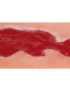 Moulage d'un ulcère veineux de jambe, petit, granulant... 2