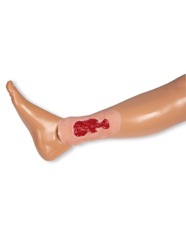 Moulage de herida de úlcera venosa de pierna,...