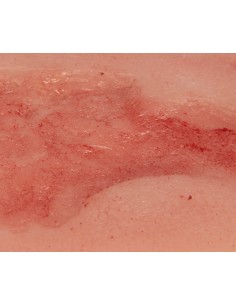 Moulage of lower extremity venous ulcer wound, small,... 2
