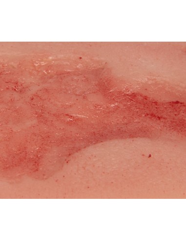 Moulage de herida de úlcera venosa de miembro...