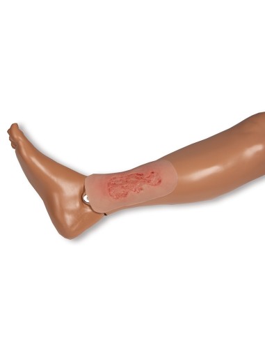 Moulage d'une plaie d'ulcère veineux du membre...