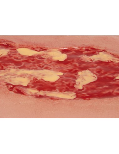 Moulage of lower extremity venous ulcer wound,...