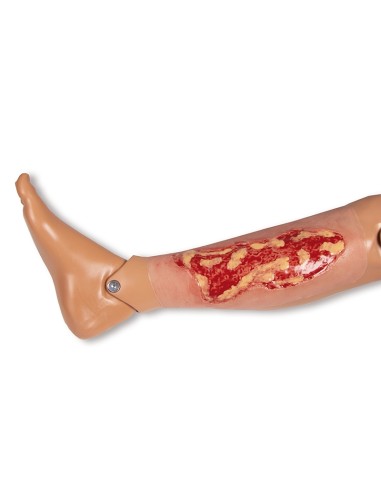 Moulage einer venösen Ulkuswunde der unteren...