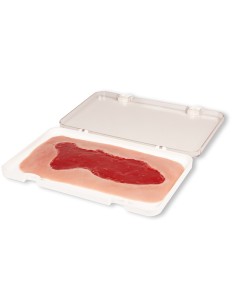 Moulage of lower extremity venous ulcer wound, large, in...