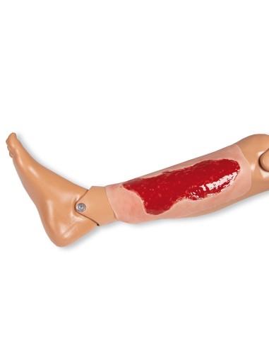 Moulage d'une plaie d'ulcère veineux du membre...