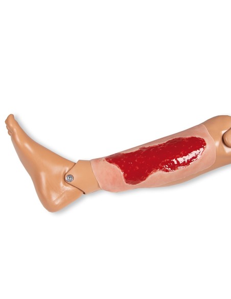 Moulage di ferita da ulcera venosa degli arti inferiori, ampia, in fase di granulazione Erler Zimmer PW003B