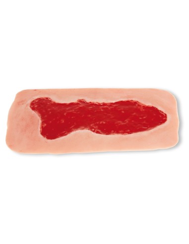 Moulage de herida de úlcera venosa de miembro...