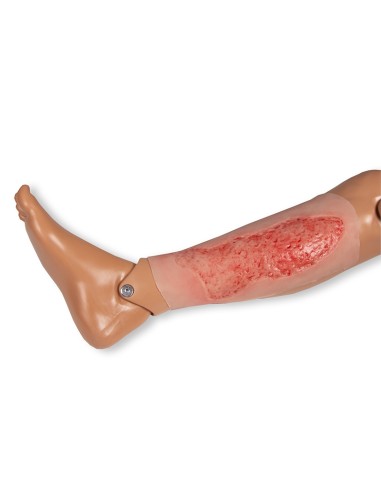 Moulage eines venösen Ulkus der unteren...