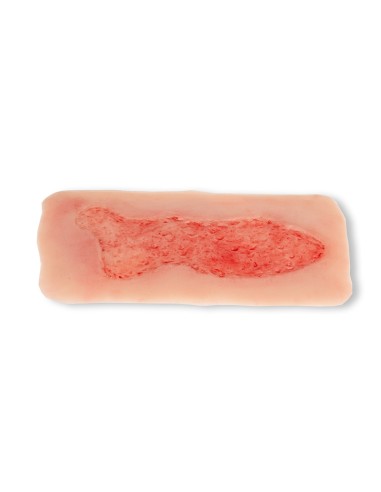 Moulage of lower extremity venous ulcer wound,...