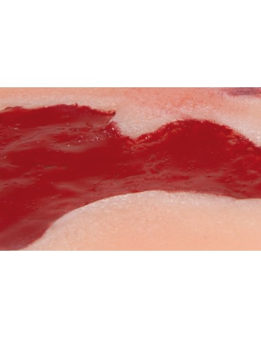 Moulage di ferita da ulcera arteriosa degli...