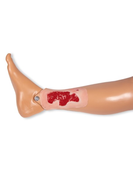 Moulage de herida de úlcera arterial de miembro inferior, pequeña, granulante Erler Zimmer PW004B