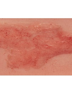 Moulage of lower limb arterial ulcer wound, small,... 2