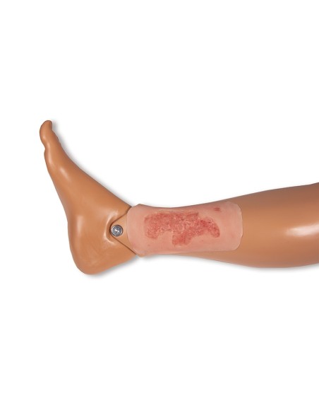 Moulage of lower limb arterial ulcer wound, small, epithelializing Erler Zimmer PW004C
