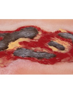 Moulage of lower limb arterial ulcer wound, large,... 2
