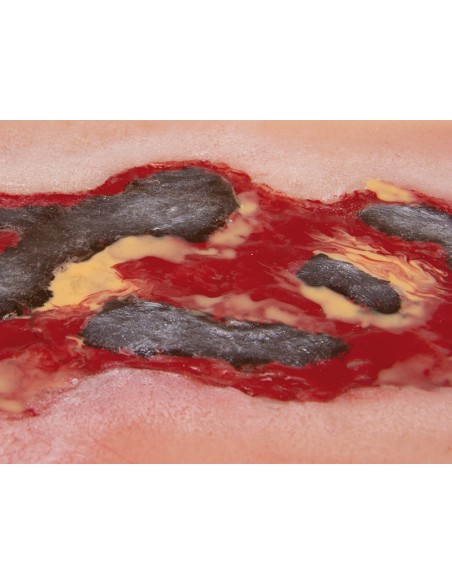 Moulage eines Ulkus der unteren Extremitäten, groß, exsudierend Erler Zimmer PW005A