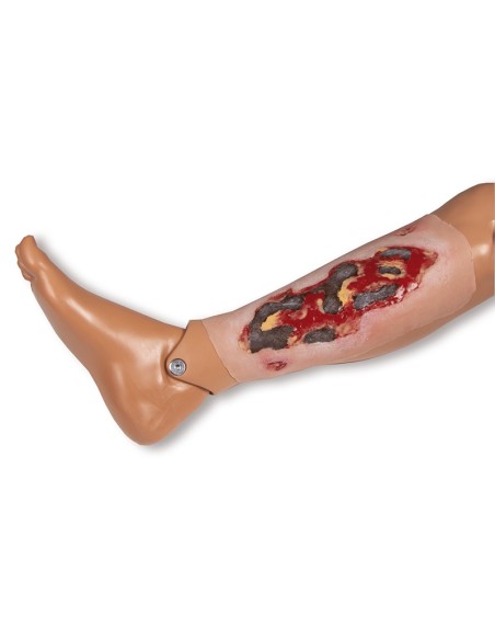 Moulage d'une plaie d'ulcère du membre inférieur, large, exsudative Erler Zimmer PW005A