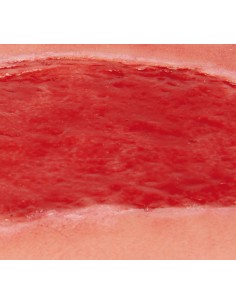 Moulage di ferita da ulcera arteriosa degli arti... 2