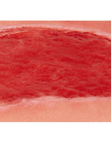 Moulage di ferita da ulcera arteriosa degli...