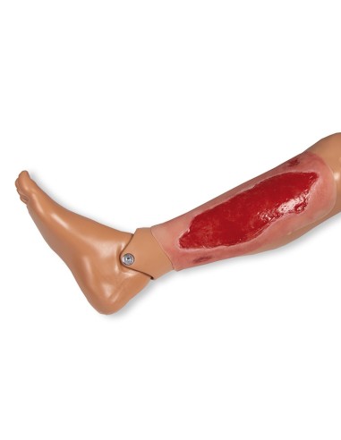 Moulage de herida de úlcera arterial de miembro...