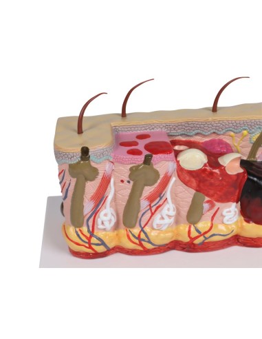Modèle de peau pathologique avec brûlures,...