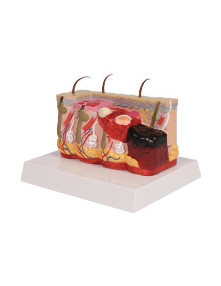 Modello di pelle patologica con ustioni, ingrandita 30 volte Erler Zimmer EZ-J751