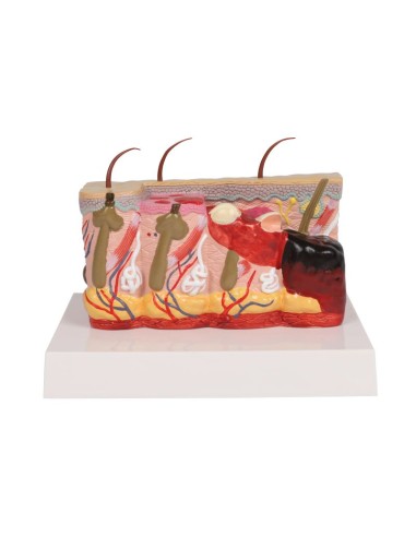 Pathologisches Hautmodell mit Verbrennungen,...